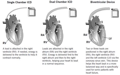 You can always come back for biventricular pacemaker icd 10 code because we update all the latest coupons and special deals weekly. Luke's radiology blog - Blog