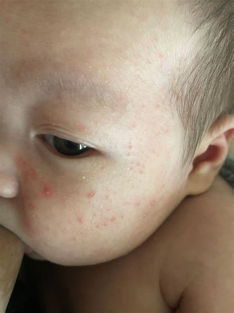 Rash Baby Pimples Or Something Else Babycenter