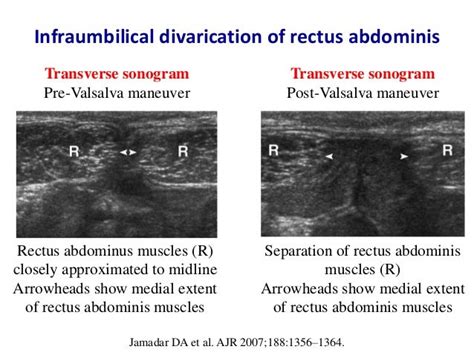 Ultrasound Of Groin And Anterior Abdominal Wall Hernias