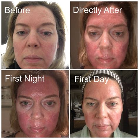 Kara Jensen Info Skin Cancer On Face Treatment