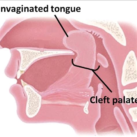 Schema Of Larynx In Case 1 Is Shown The Tongue Of Patient Protrudes To