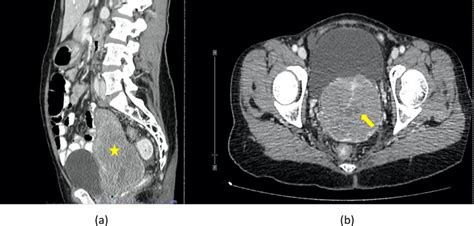 Contrast Enhanced Ct Scan At The Pelvis In Both A Sagittal And B