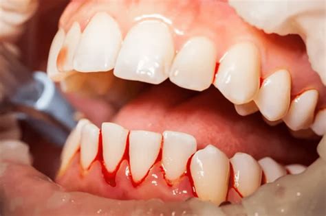 is gum disease serious dentist in owen s cross roads al
