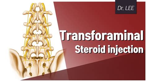 L5 Transforaminal Epidural Steroid Injection