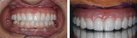 Dental Implants Neutral Bay Shore Dental