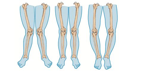 3d Printing Helps Reverse Bowed Legs In Hong Kong Study