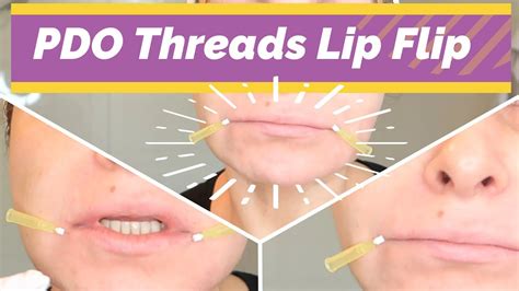 Pdo Threads Lip Flip 30gx25mm Pcl Threads Lips Anti Aging Pdo