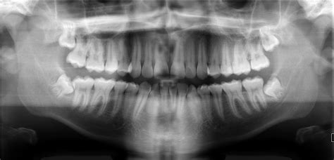 Canine d on a dental radiograph the alveolar crest is typically located _____ mm below the junction of the crown and the root surfaces. Different X-Ray Types | Texas Center For Cosmetic Dentistry