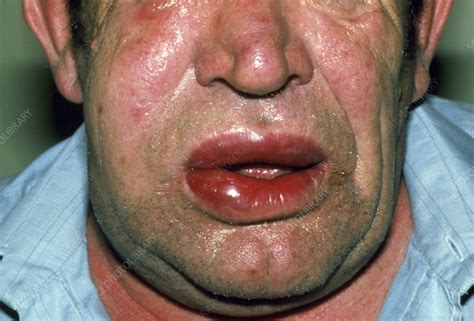 Angioedema Of Lips Due To Allergic Reaction Stock Image M3200175
