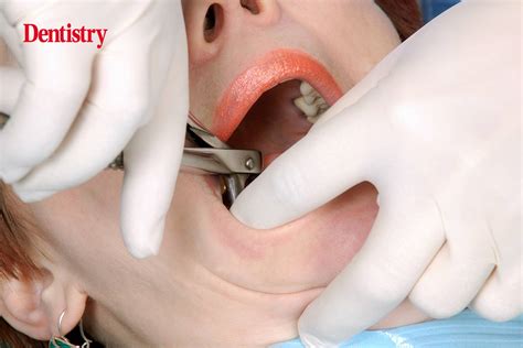Women Breaks Into Practice And Extracts 13 Teeth From Patient Dentistry