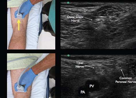 Posterior Tibial Nerve Block Ultrasound