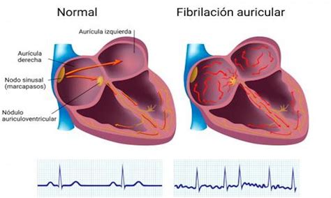 ¿qué Es La Fibrilación Auricular ¿tiene Cura Cardiología Deportiva