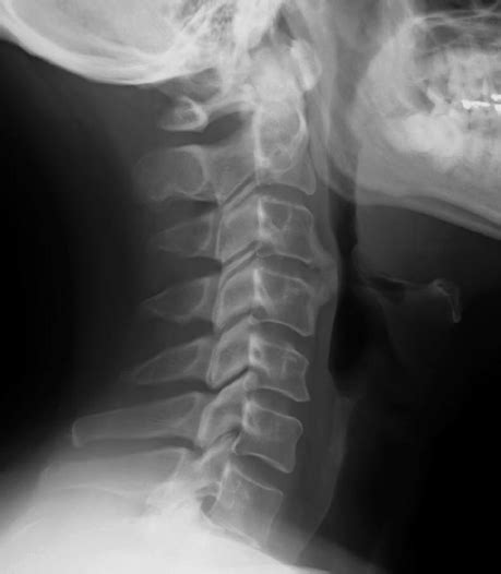 Lateral Radiography Of The Cervical Spine Showing An Anterior