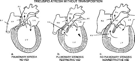 Tricuspid Atresia Congenital Heart Disease Mitch Medical