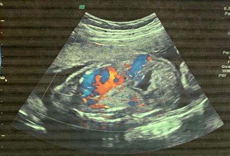 Fetal Us At 20 Weeks Gestation Showing An Echogenic Mass In The Left