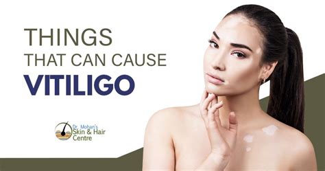Major Causes Of Vitiligo