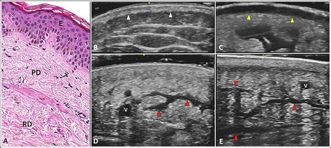 Ultrasound Examination Vs Magnetic Resonance Imaging In Lymphedema
