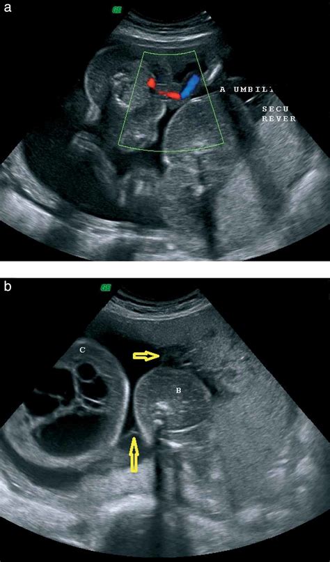 Triplets Ultrasound 30 Weeks