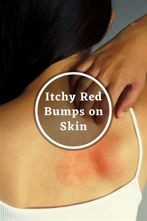 Itchy Red Bumps On Skin Itchy Red Bumps Skin