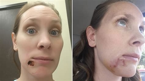 This Womans Blackhead Turned Out To Be Skin Cancer Allure