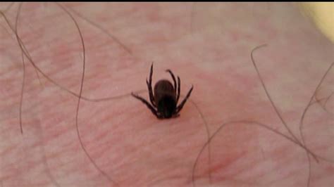 Pa Dept Of Health Tick Season Is Here And Some Lyme Disease Symptoms