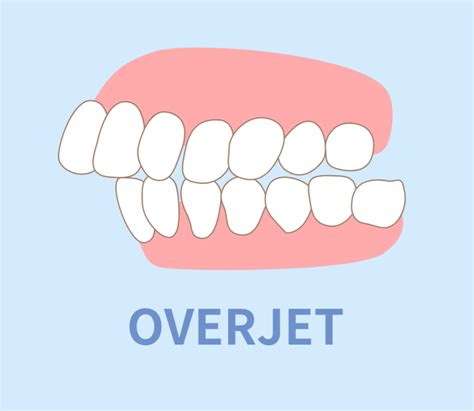 Underbite Vs Overbite What’s The Difference And How Are They Treated Hawley Orthodontics