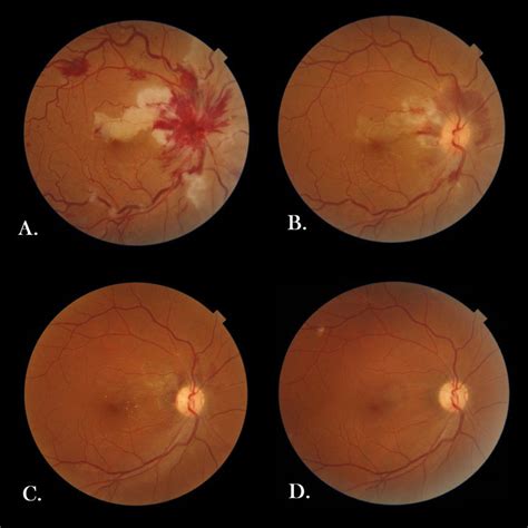 Fundus Photo Of The Patient A Fundus Photo Of The Right Eye Revealed
