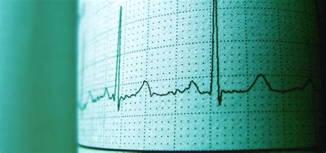 Heart Arrhythmia Irregular Heartbeat Causes Symptoms Diagnosis And