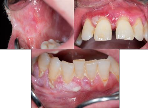 Oral Lichen Planus And Related Lesions What Should We Accept Based On
