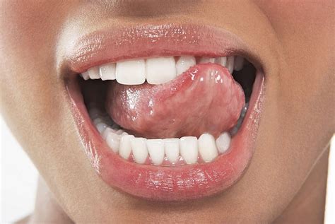 Oral Thrush 10 Oral Thrush Symptoms