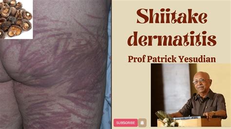 Shiitake Dermatitis Youtube