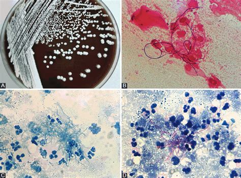 Nocardia Species Identification Clinical Characteristics And
