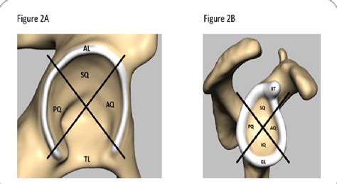 Shoulder labrum slap tear injury | feat. Labral quadrants of (A) the hip and (B) shoulder. A. AL: Acetabular... | Download Scientific Diagram