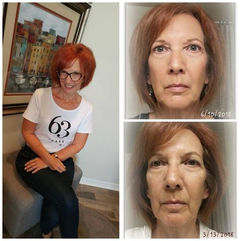 A Natural Face Lift To Look And Feel Younger Face Lift Exercises Facial Exercises Anti Aging