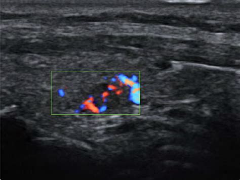 Intra Thyroid Parathyroid Adenoma Demonstrated On Ultrasound Image