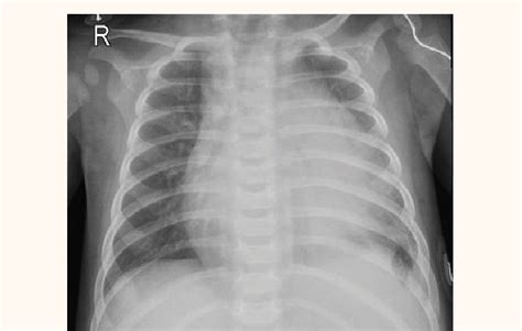 Chest X Ray Of A Four Month Old Female Infant With Pericardial Effusion Download Scientific