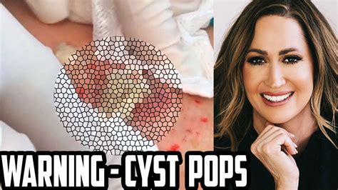 Derm Diva Pops Cysts Warning Blackheads Pimples Cyst Removal Youtube