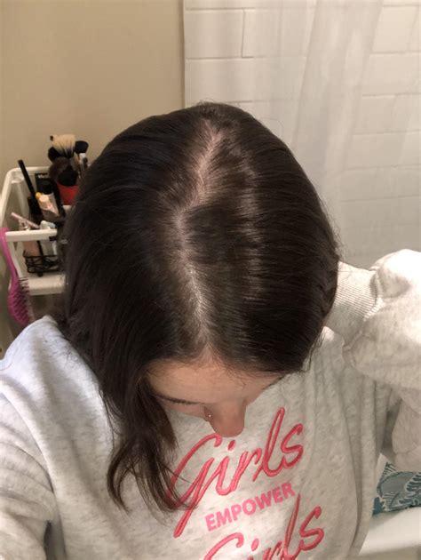 27f Ive Been Experiencing Hair Thinning Over The Last 34 Years I Do