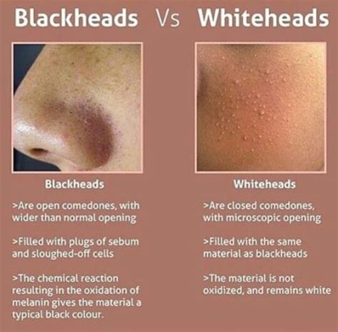 Blackheads VS Whiteheads WhiteheadsRemoval Whiteheads Skin Care Skin Care Tips