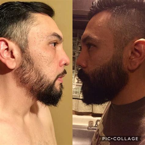 Minoxidil Before And After Beard