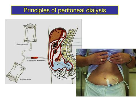 Ppt Peritoneal Dialysis Powerpoint Presentation Free Download Id