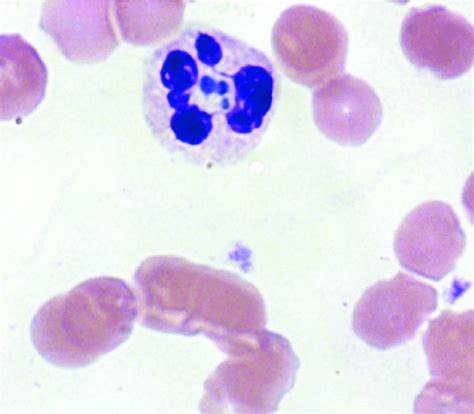 Anaplasma Phagocytophilum Morulae Observed On Peripheral Blood Smear