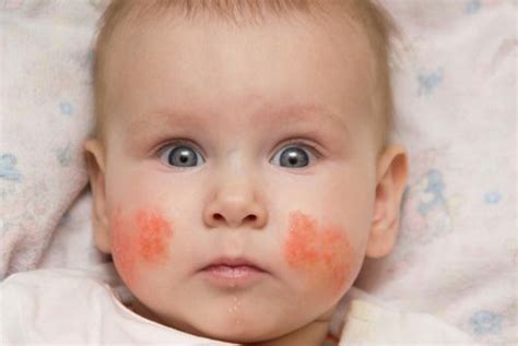 All You Need To Know About Slapped Cheek Disease In Children