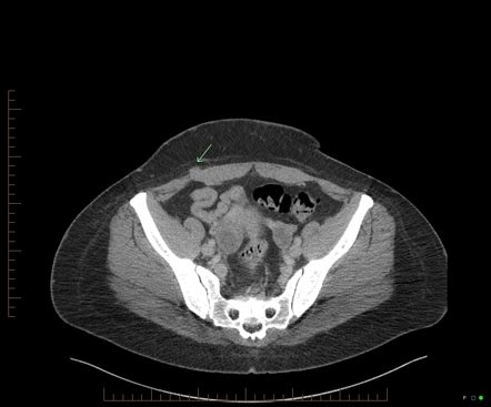 Cesarian Scar Endometriosis Radiology Reference Article Radiopaedia Org