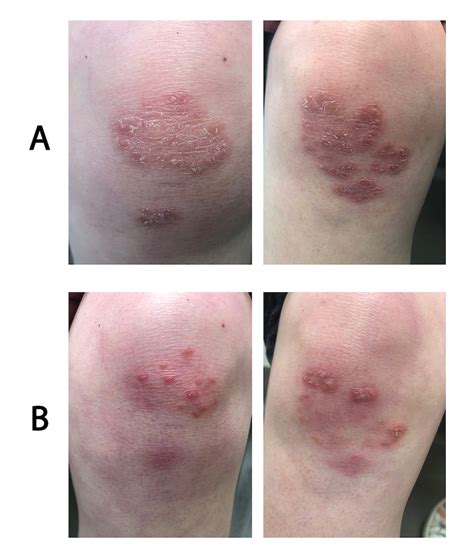The Impact And Treatment Of Psoriasis In Manitoba Dermatology Clinics