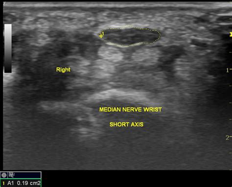 Carpal tunnel syndrome | Image | Radiopaedia.org