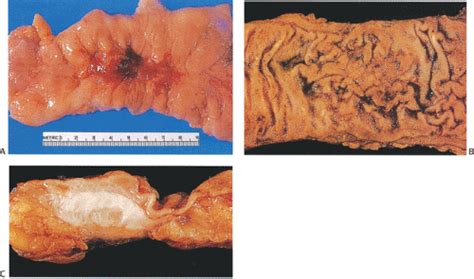 Endometriosis is a common, benign, and chronic disease in women of reproductive age that is characterized by the occurrence of endometrial tissue outside the uterus. Endometriosis and Endosalpingiosis | Abdominal Key