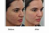 Photos of Recovery Time Co2 Laser Skin Resurfacing