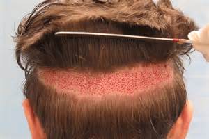 Hair Transplant Side Effects And Precautions Mighty News