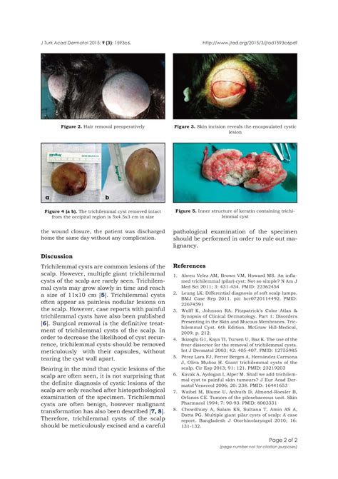 Mehmet Eren Yuksel Multiple Giant Trichilemmal Cysts Of The Head Case